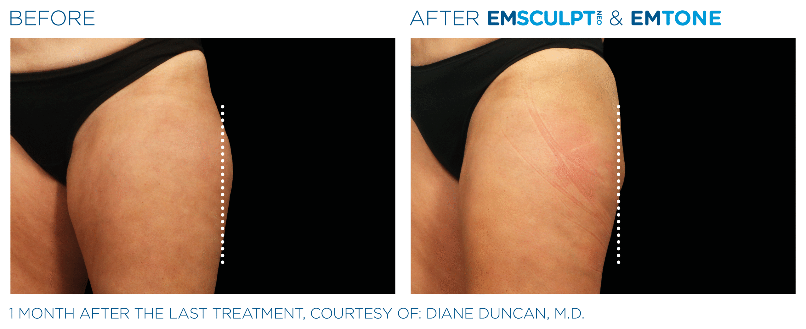 Emsculpt_Neo-Emtone_PIC_Ba-card-female-outer-thigh-006_ENUS100 (1)