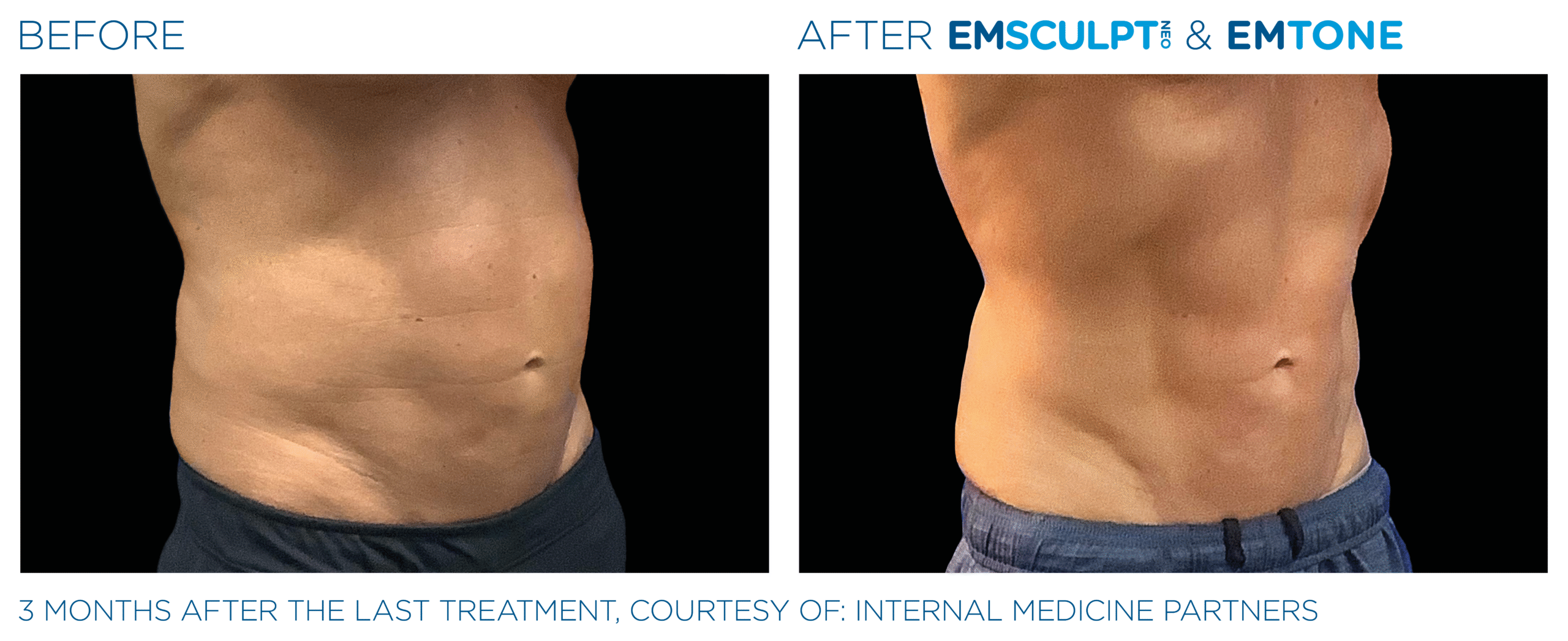 Emsculpt_Neo-Emtone_PIC_Ba-card-male-abdomen-014_ENUS100