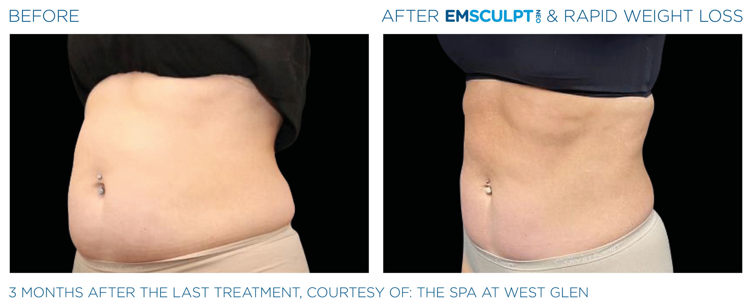 Emsculpt_Neo-Weight-Loss_PIC_Ba-card-female-abdomen-003_ENUS100
