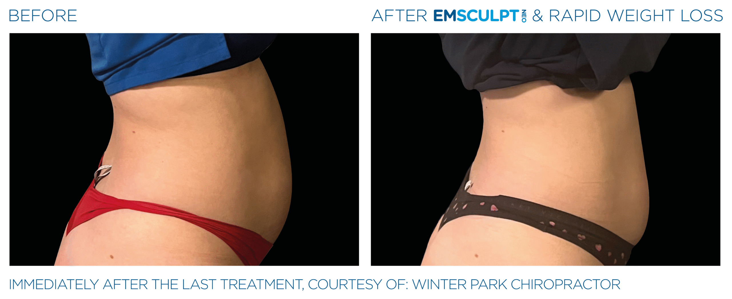 Emsculpt_Neo-Weight-Loss_PIC_Ba-card-female-abdomen-012_ENUS101