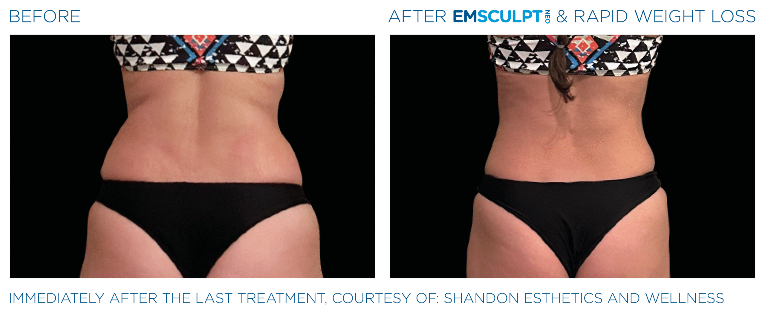 Emsculpt_Neo-Weight-Loss_PIC_Ba-card-female-lateral-abdomen-008_ENUS100