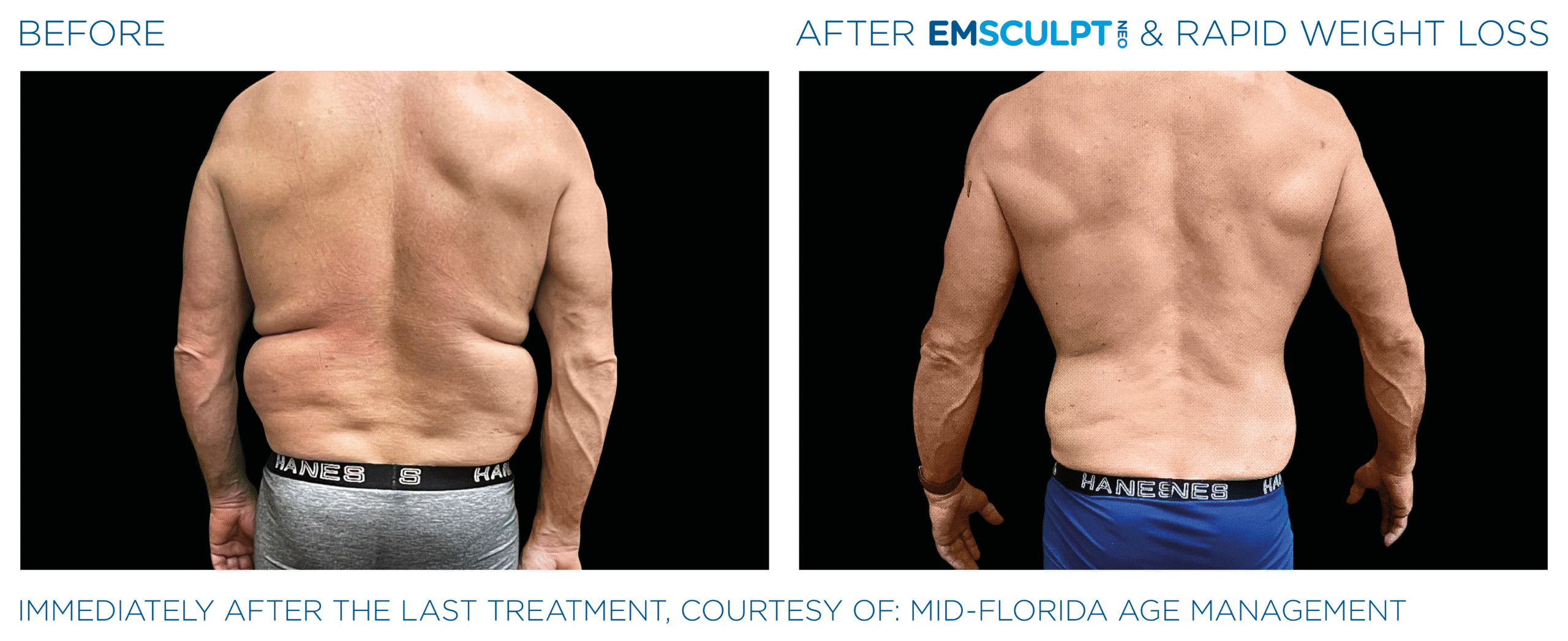 Emsculpt_Neo-Weight-Loss_PIC_Ba-card-male-lateral-abdomen-011_ENUS100