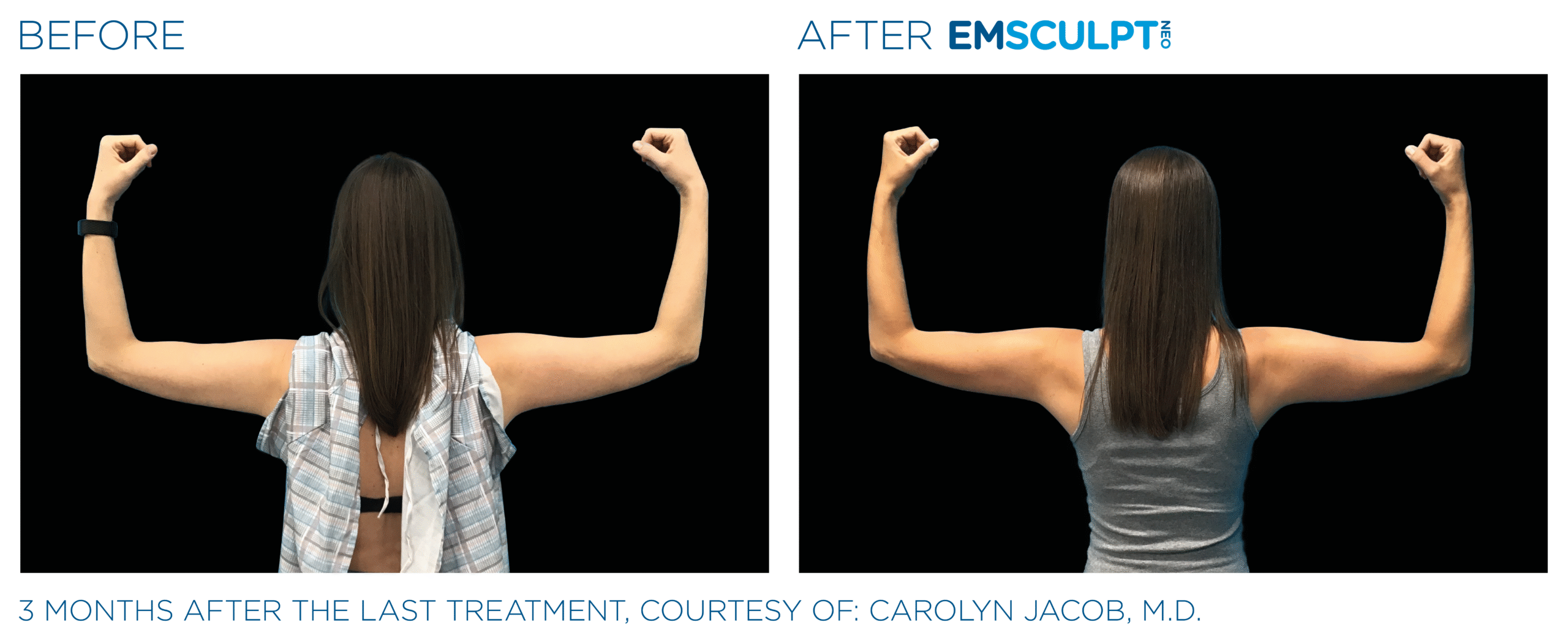 Emsculpt_Neo_PIC_Ba-card-female-arms-079-B_ENUS100