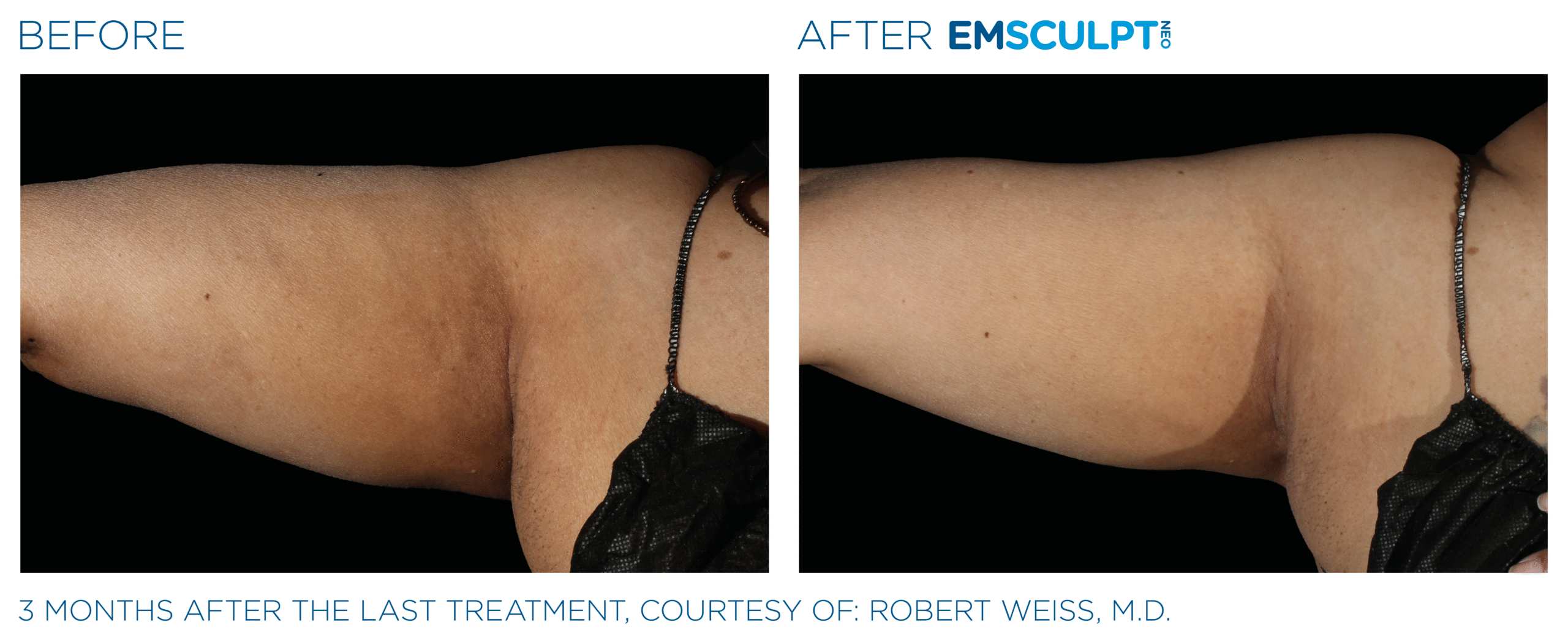 Emsculpt_Neo_PIC_Ba-card-female-arms-080_ENUS100