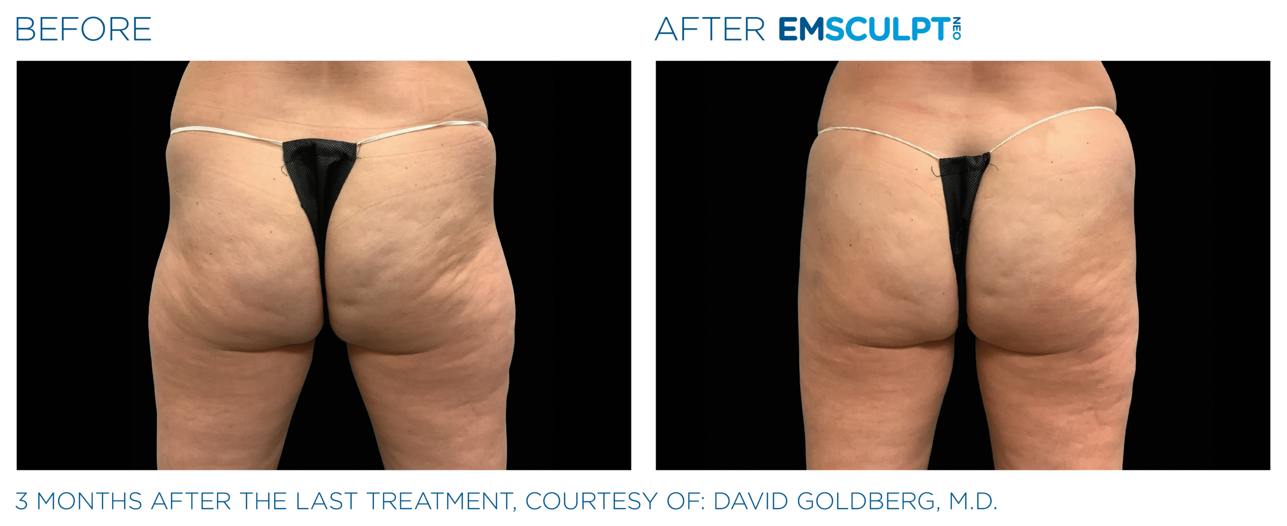 Emsculpt_Neo_PIC_Ba-card-female-buttock-097_ENUS100