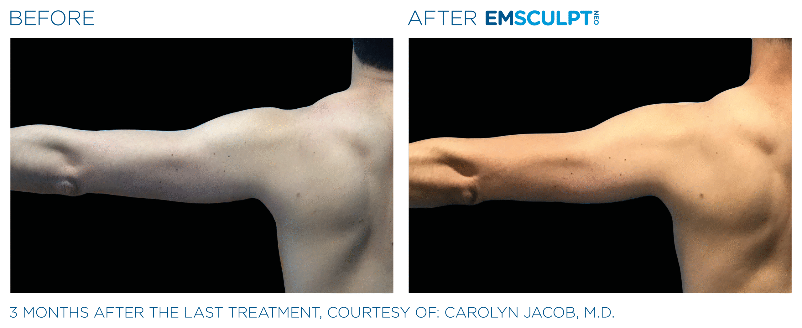 Emsculpt_Neo_PIC_Ba-card-male-arms-095_ENUS100