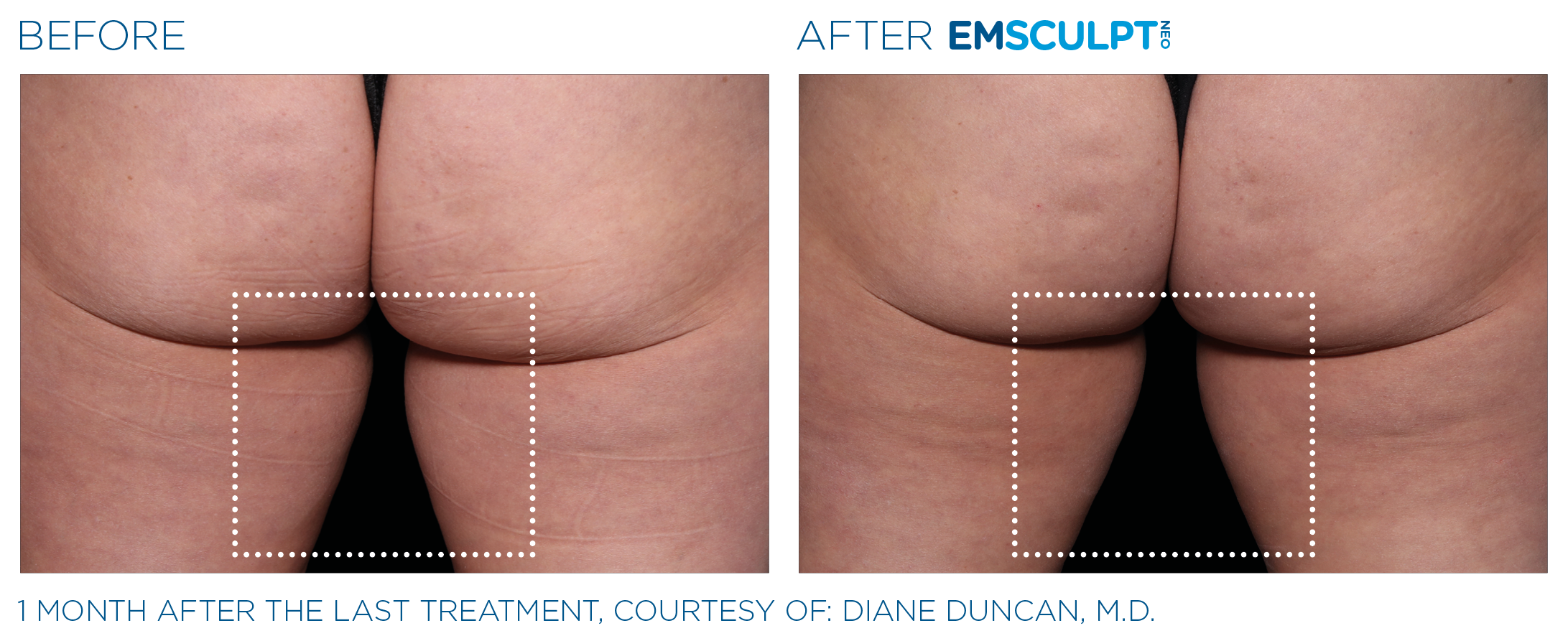 Emsculpt_neo_PIC_Ba-card-female-inner_thighs-068_ENUS100