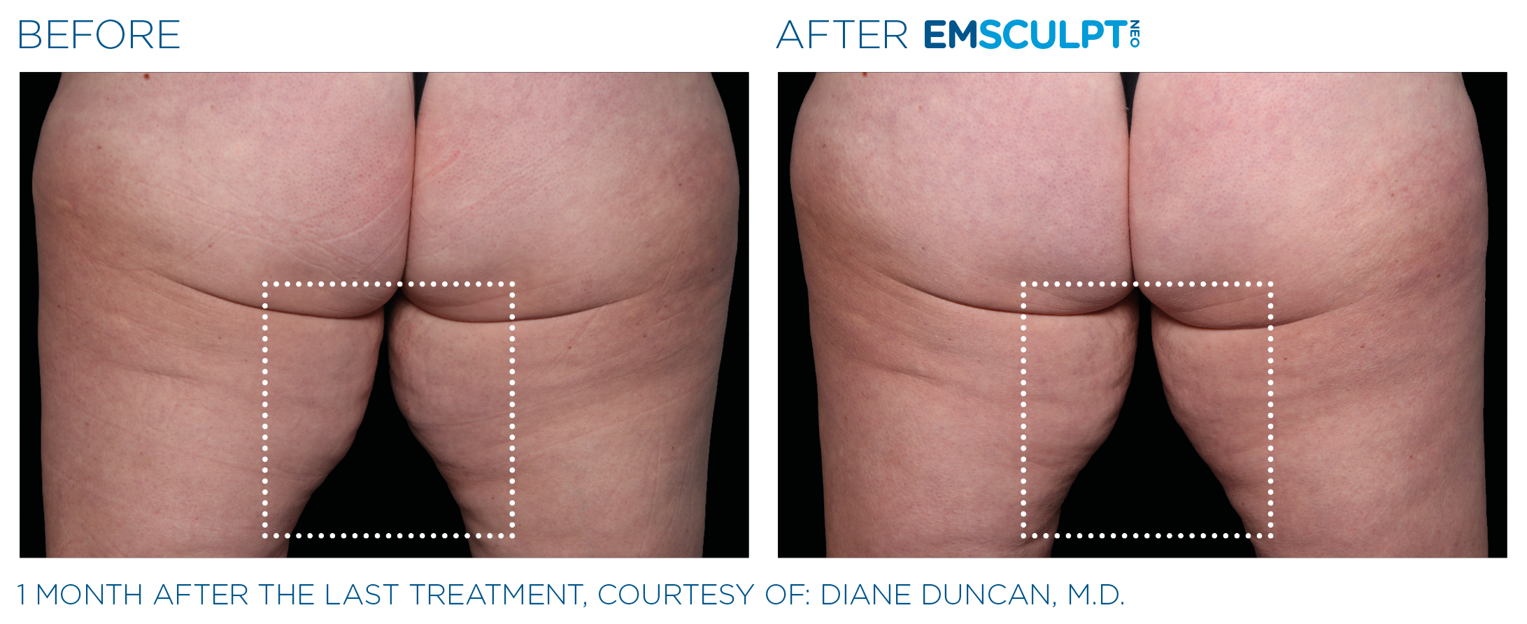 Emsculpt_neo_PIC_Ba-card-female-inner_thighs-069_ENUS100