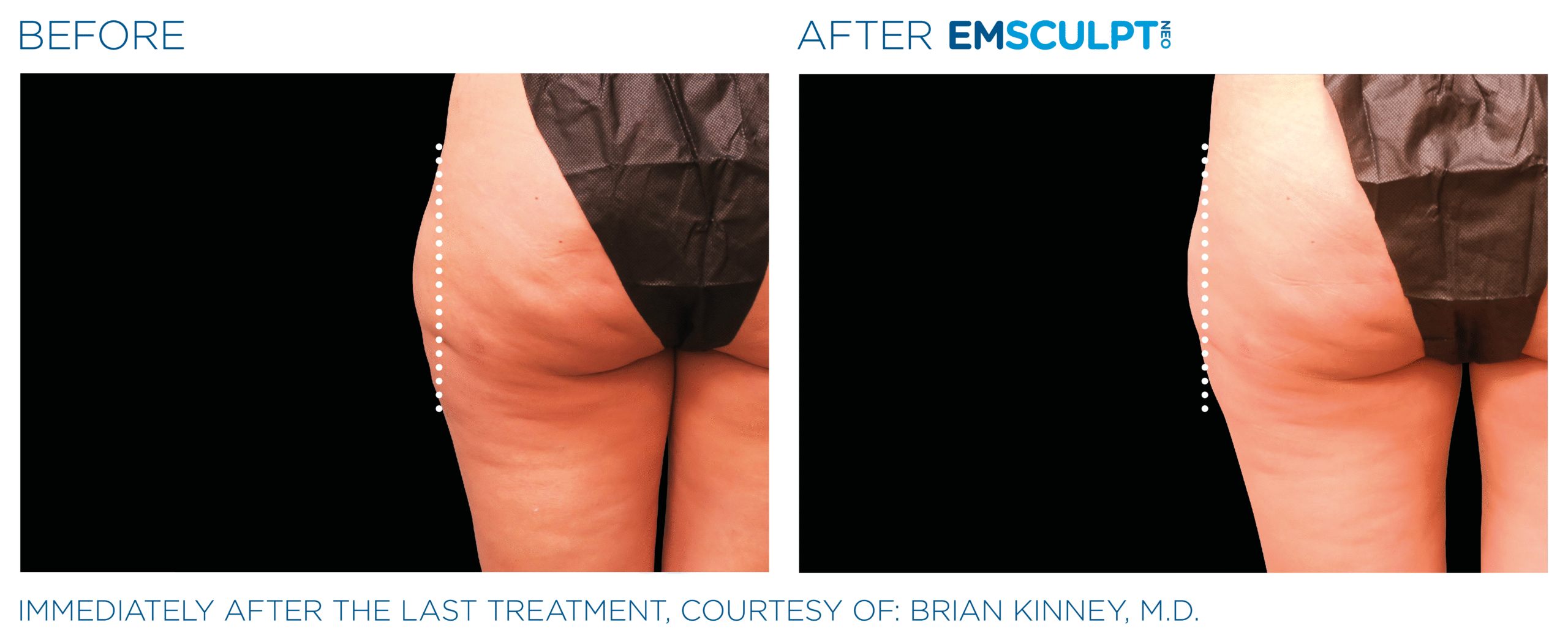 Emsculpt_neo_PIC_Ba-card-female-outer_thighs-092_ENUS100