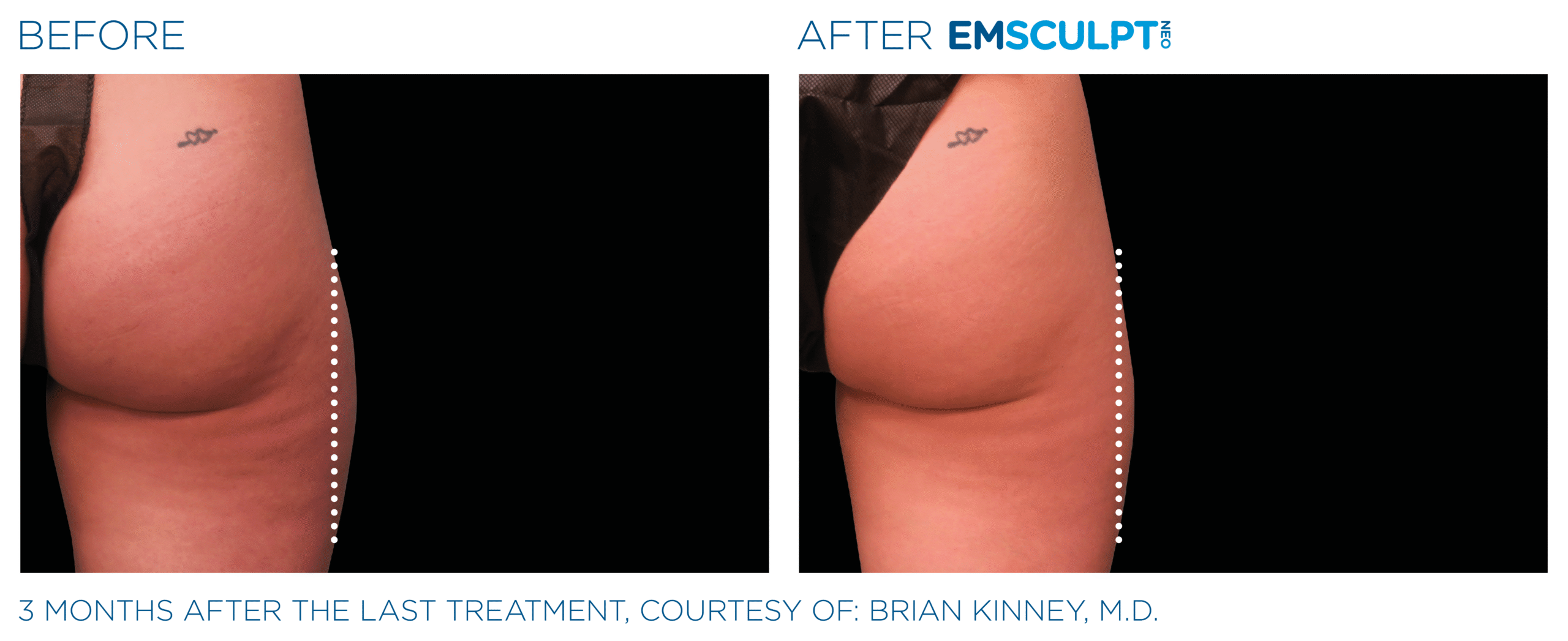 Emsculpt_neo_PIC_Ba-card-female-outer_thighs-093_ENUS100