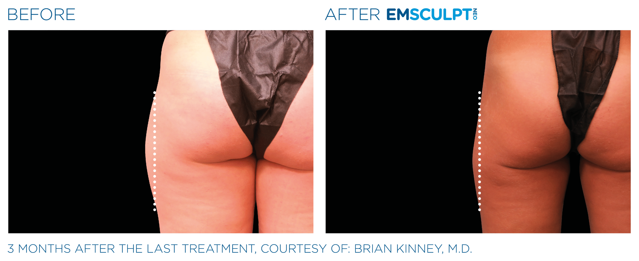 Emsculpt_neo_PIC_Ba-card-female-outer_thighs-094_ENUS100