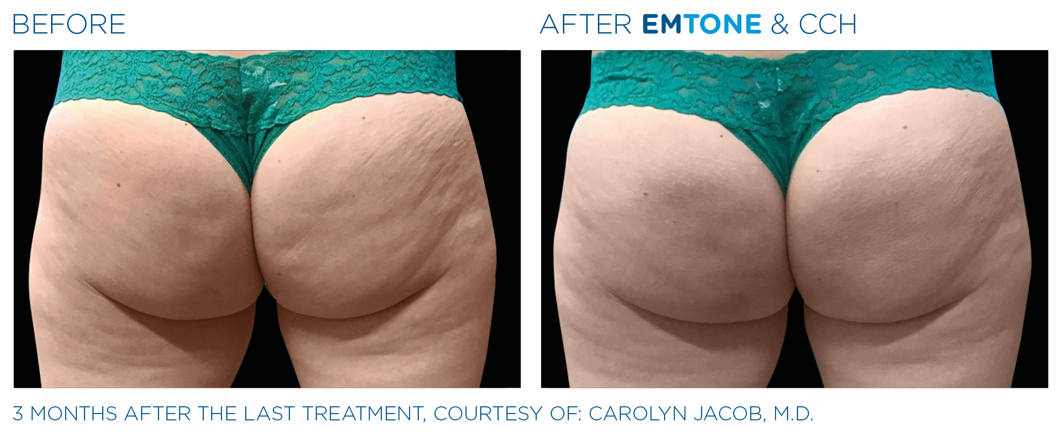 Emtone_PIC_Ba-card-female-buttock-045_ENUS100